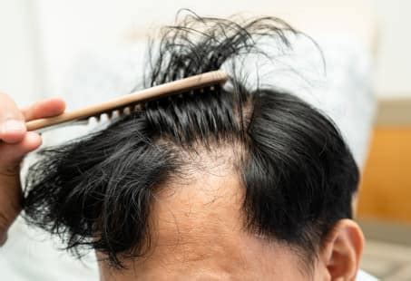 Ringworm Hair Loss: Signs, Causes & Treatments | Longevita