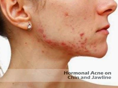 Hormonal Acne on Chin and Jawline - Cause and Treatment | Hormonal Acne Tips