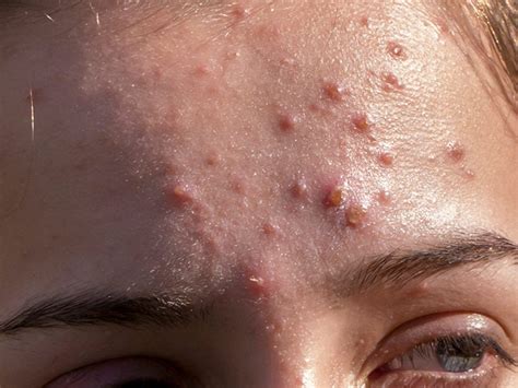 Understanding Cystic Acne: A Comprehensive Guide by a Dermatologist