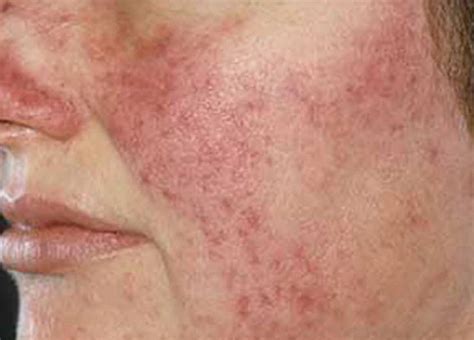 Condition Spotlight - Rosacea - Alaska Family Dermatology