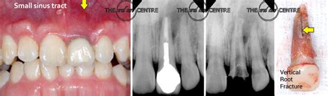 Cracked tooth - Oralcare