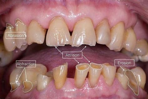 Signs, Causes, And Treatments For Dental Abrasion: A Comprehensive ...