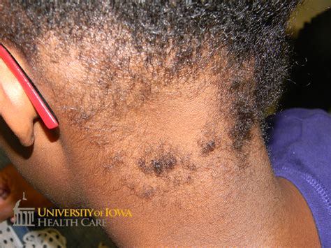 Multiple round patches of nonscarring alopecia on the scalp. (click images for higher resolution).