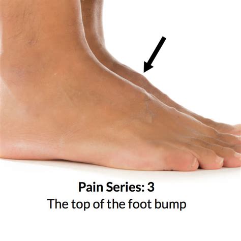 "Top of Foot" Pain