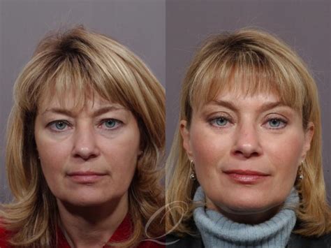 Mid Facelift Before & After Photo Gallery | Serving Rochester, Syracuse & Buffalo, NY | Quatela ...