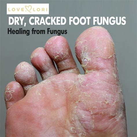 Dry Cracked Feet Fungus, Toenail Fungus, and Athlete's Foot Cures – Love, Lori