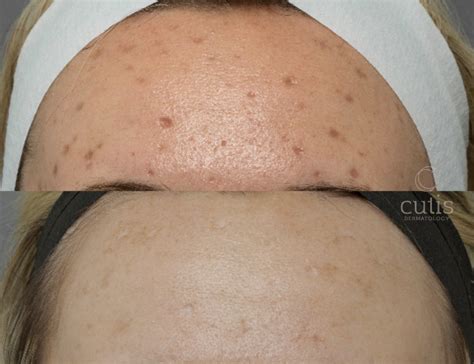 Chicken Pox Scars - Cutis Dermatology