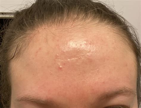 [Skin Concerns] Need help! Is this acne? Have had this for 2+ months and I can’t get rid of them ...