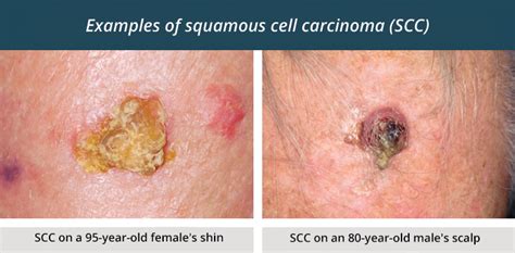 anexar Ás Picar basal cell carcinoma on leg Escreva étnico carga