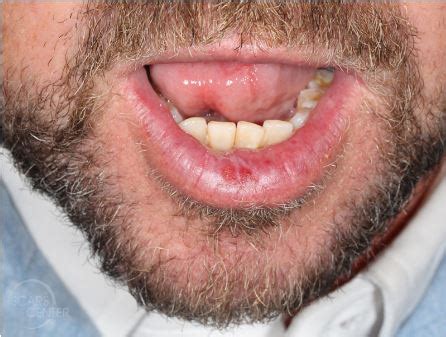 Symptoms Of Skin Cancer On Lower Lip | Sitelip.org