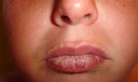 Signs Of Lip Cancer From Sun | Sitelip.org