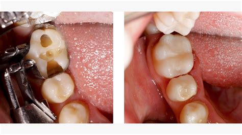 Small Cavity Filling