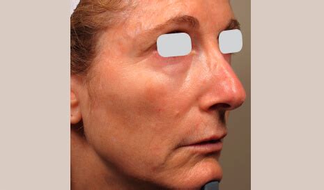 Fine Lines & Wrinkles Treatment | Aesthetipedia.com