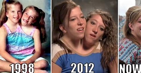 Fascinating Facts About Famous Conjoined Twins Abby And (25 min) - Video | FPornVideos.com