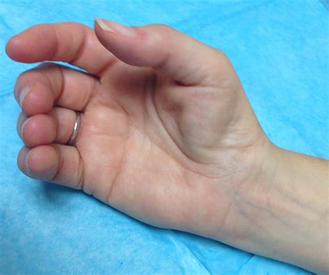 Thenar Muscle Atrophy | Hand Surgery Source