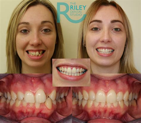 Invisalign Before And After Crowding