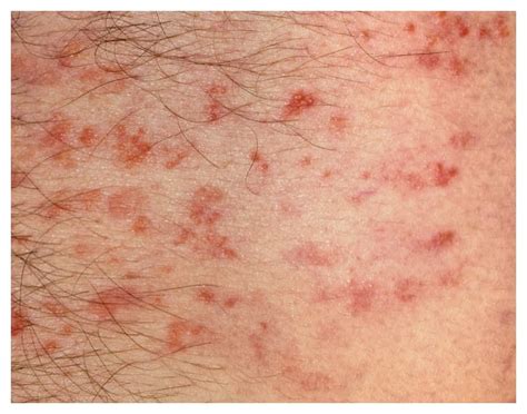 Psoriasis Symptoms | psoriasisSPEAKS