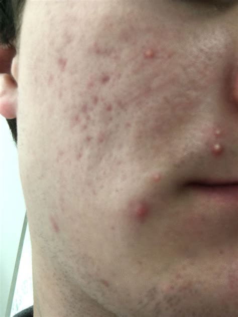 [Skin Concerns] what kind of acne is this, and what can I do to improve it : SkincareAddiction