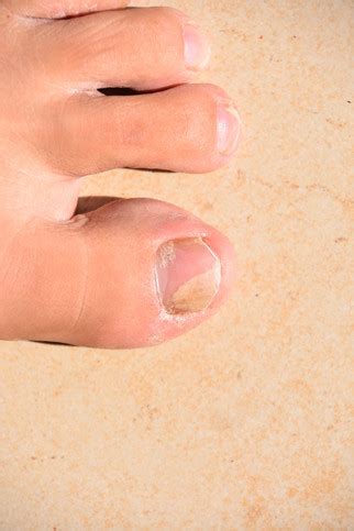 Staying one step ahead of toenail fungus - Harvard Health