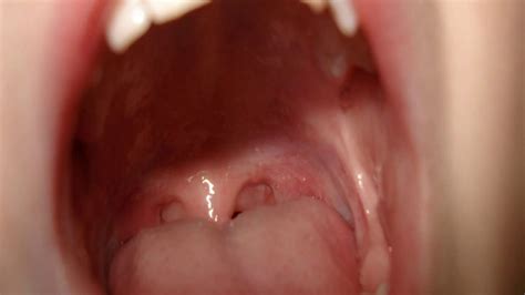 Post Nasal Drip Physical Exam Findings