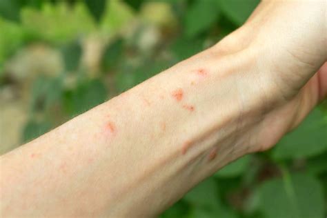 Poison Ivy Rash: Pictures, What to Do, and Prevention