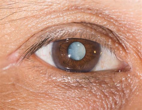 Types of Cataracts | London Cataract Centre