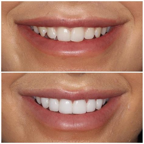 Teeth Veneers Before And After