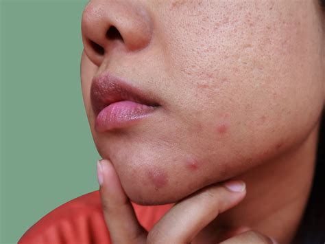 What Causes Chin Acne and How to Treat It, According to Dermatologists | SELF