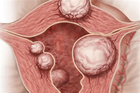 Fibroids: What Are Fibroids?