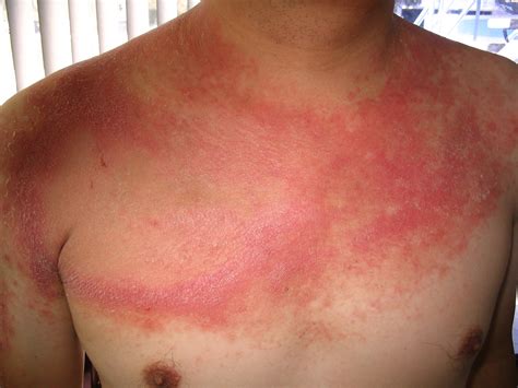 Skin Rash And Cancer