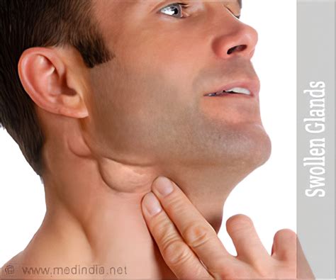 Are Swollen Glands A Symptom Of Covid 19 - NEWS April 2022