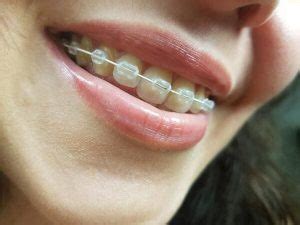 Misaligned jaw surgery – Angel Orthodontics