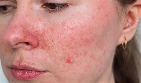 Rosacea Skin Condition - NAWI Wellness Center