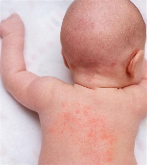 Baby Heat Rash: Types, Symptoms And Treatment