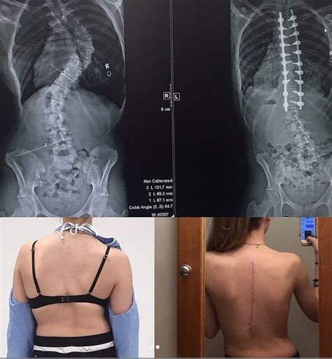 Scoliosis surgery, before and after. - MEDizzy Journal