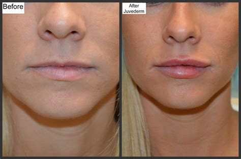 Lip Fillers Before and After Thin Lips