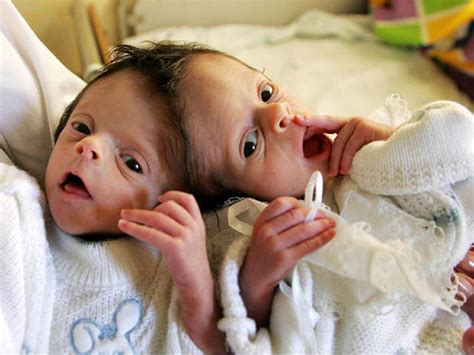 Conjoined twins - Conjoined twins (WARNING: GRAPHIC IMAGES) - Pictures - CBS News