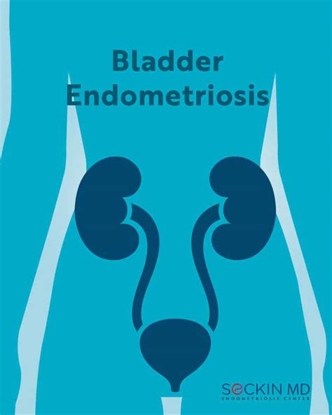 Bladder Endometriosis - Seckin Endometriosis Center