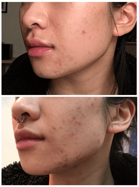 [Acne] Help! Have you experienced continuous purging after 9 weeks of Differin gel? : r ...