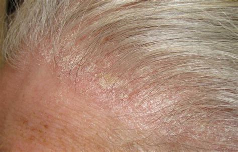 Red Spots On Scalp Pictures Causes And Treatments | Porn Sex Picture