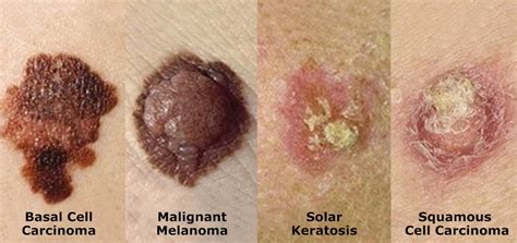 Examples Of Skin Cancer Spots