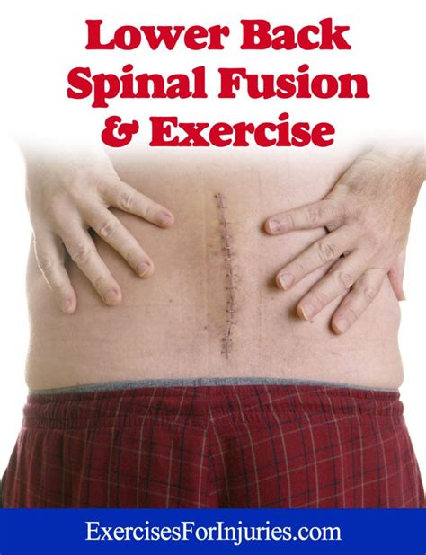 Lower Back Spinal Fusion and Exercise (Webinar) - Exercises For Injuries