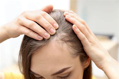 How to Stop Alopecia Areata from Getting Worse