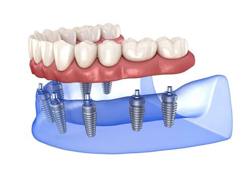 What Are the Different Types of Dental Implants? | Germantown, MD