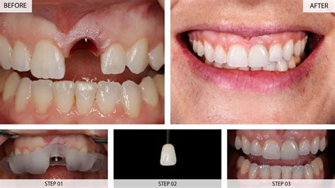 Dental Implants Results (Before & After) - 22 Cases