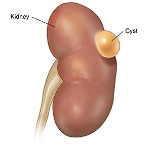 Kidney Cyst Symptoms And Treatment Options - Ask The Nurse Expert