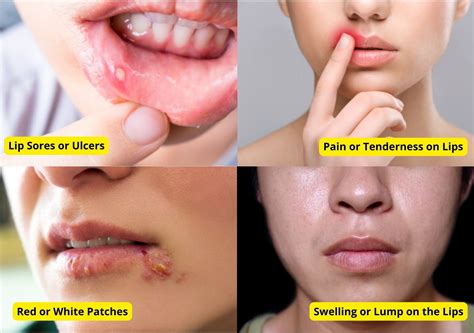 Lip Cancer: 5 Symptoms, Causes & Treatment