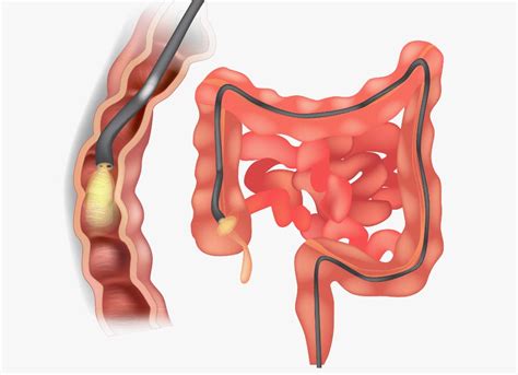 Colonoscopy | Oxford Gut and Liver