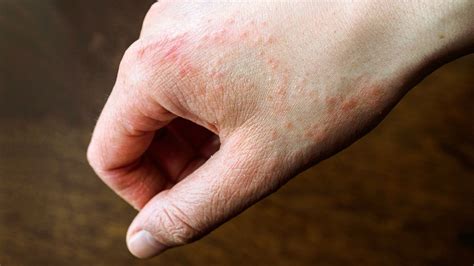 What causes a rash on your hands and feet