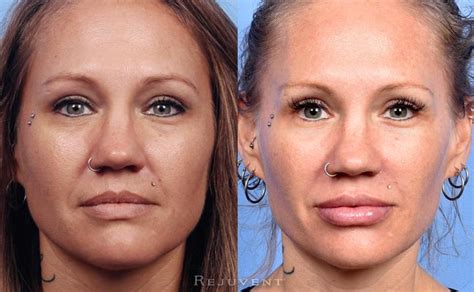 Liquid Facelift Photos Beautiful Results Rejuvent Scottsdale